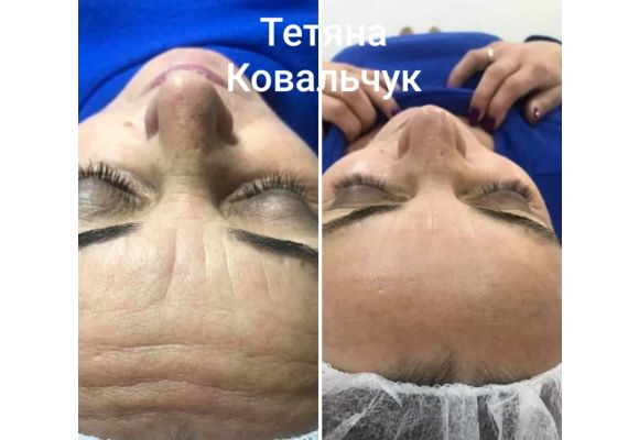 До процедуры