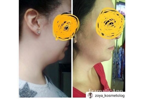 До процедуры